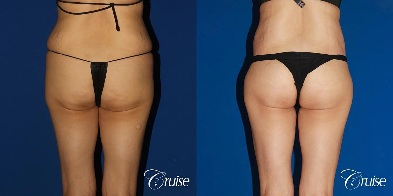 Brazilian Butt Lift Before & After