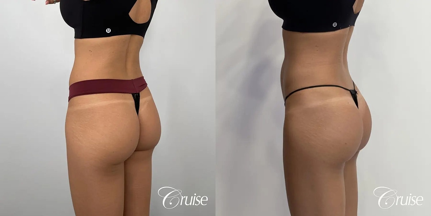Brazilian Butt Lift Before & After