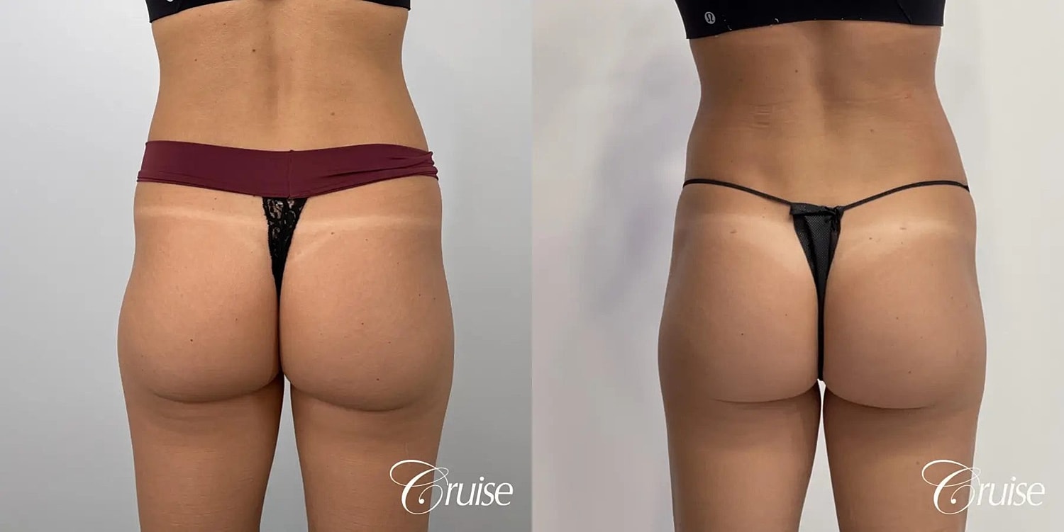 Brazilian Butt Lift Before & After