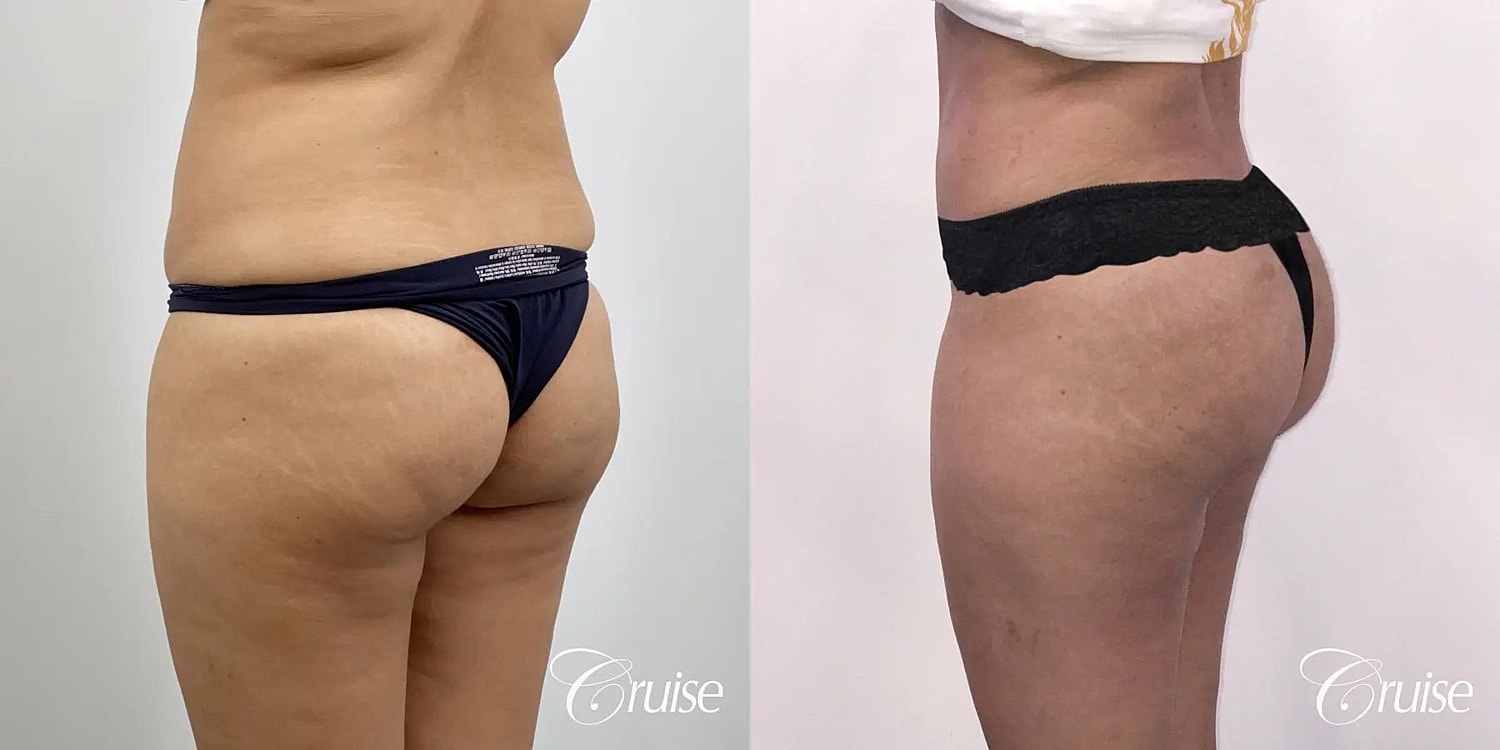 Brazilian Butt Lift Before & After