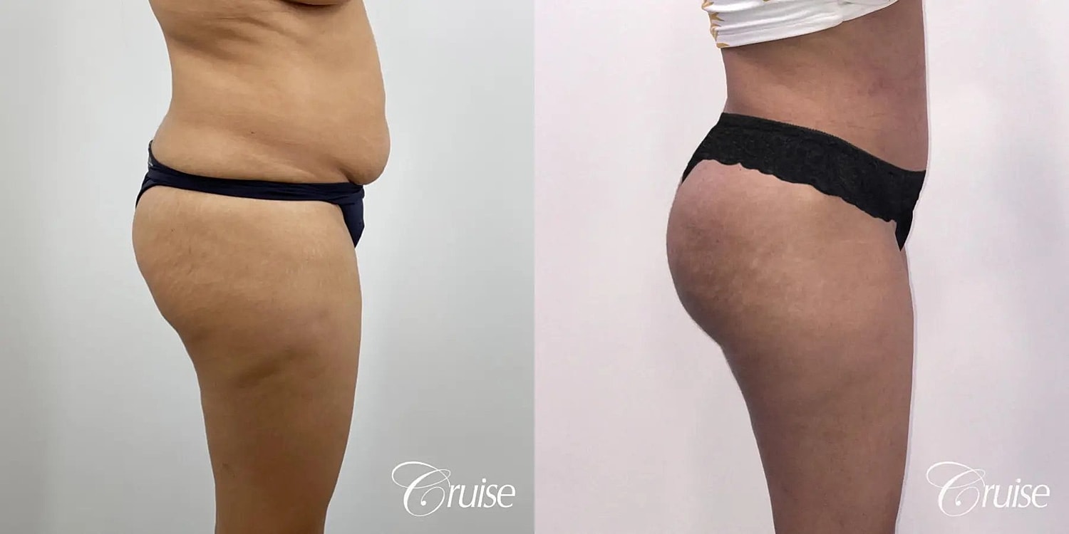 Brazilian Butt Lift Before & After