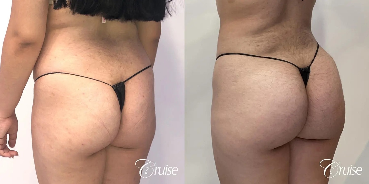 Brazilian Butt Lift Before & After