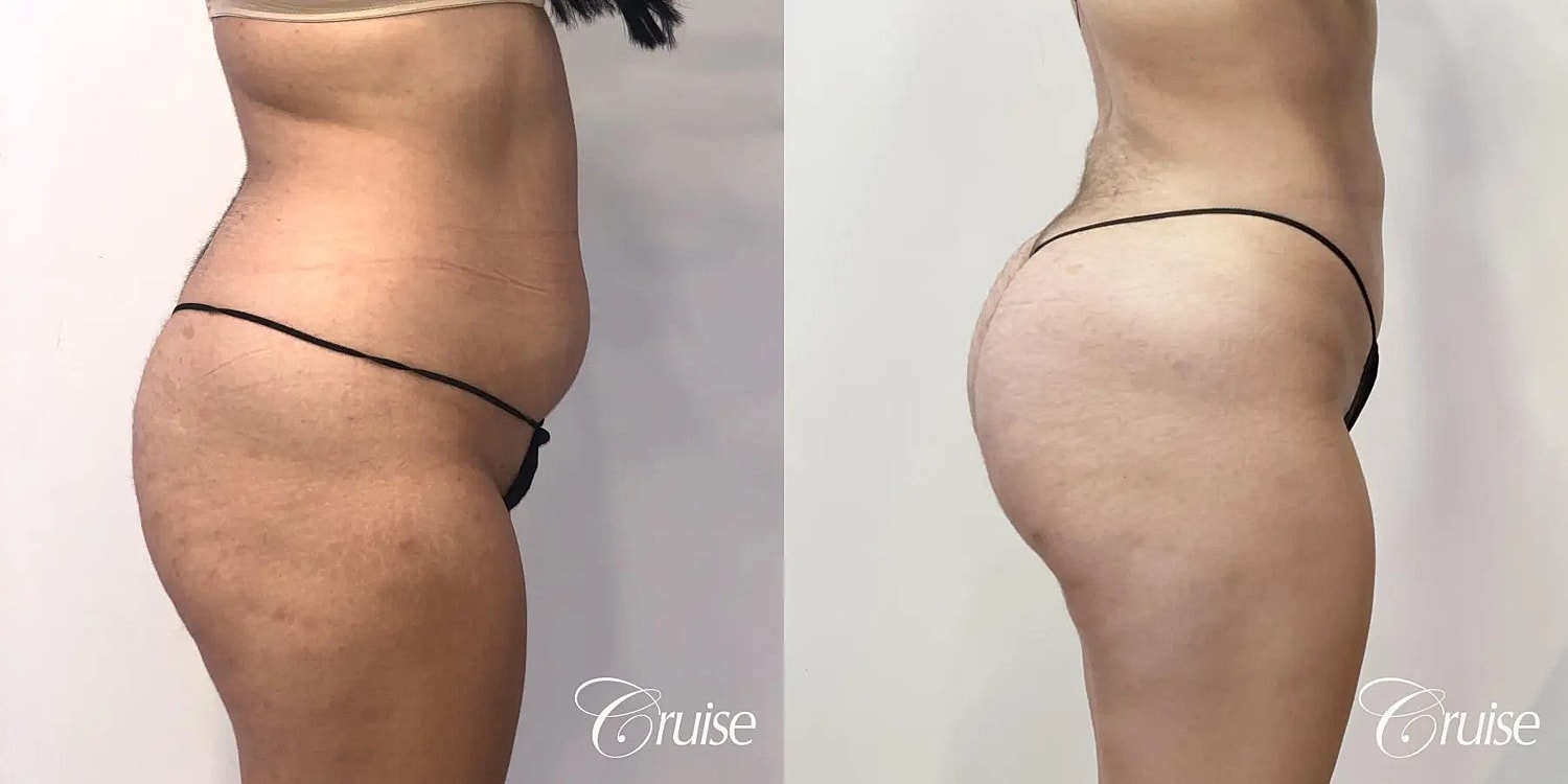 Brazilian Butt Lift Before & After