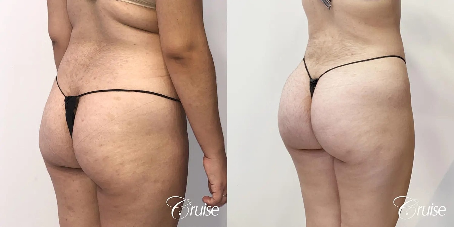 Brazilian Butt Lift Before & After