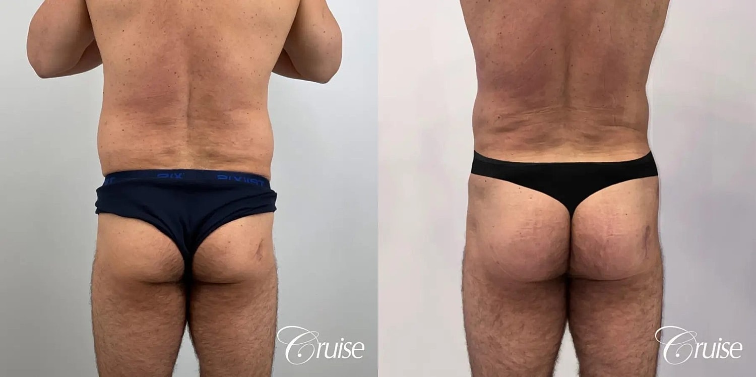 Brazilian Butt Lift Before & After