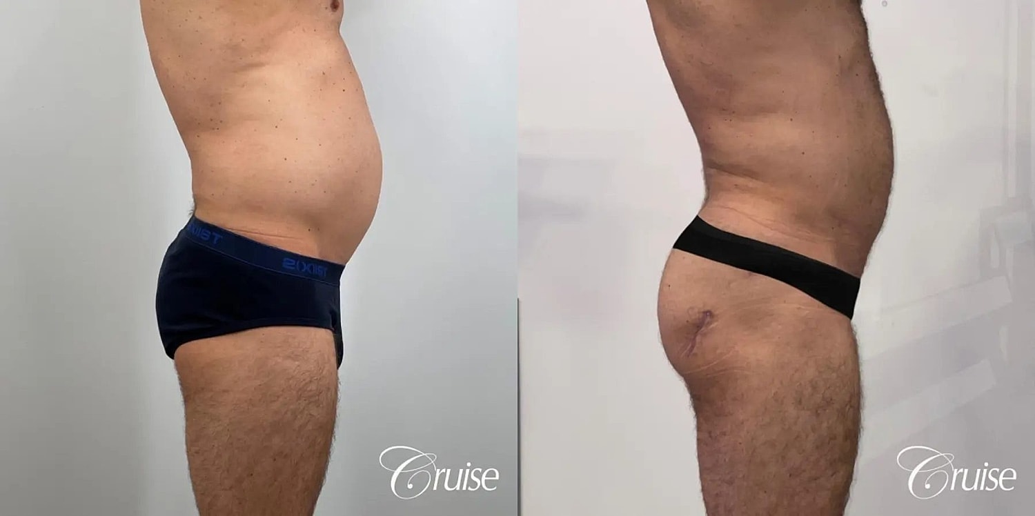 Brazilian Butt Lift Before & After