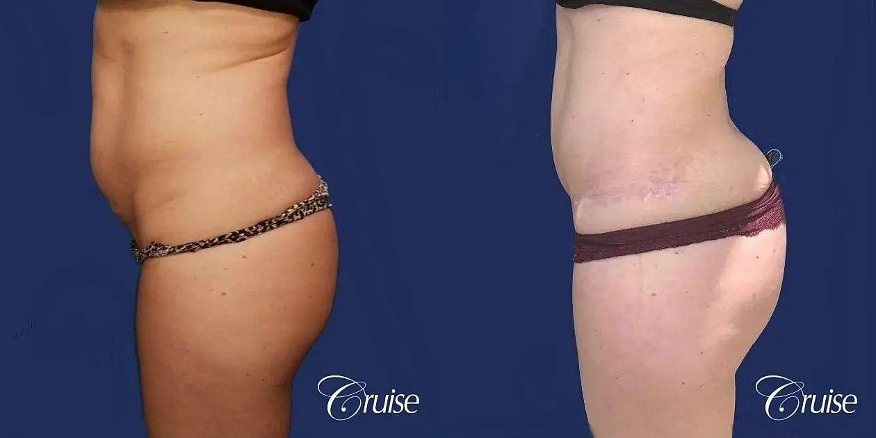 Brazilian Butt Lift Before & After