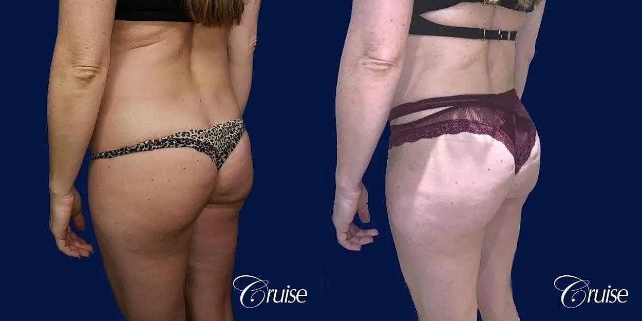 Brazilian Butt Lift Before & After