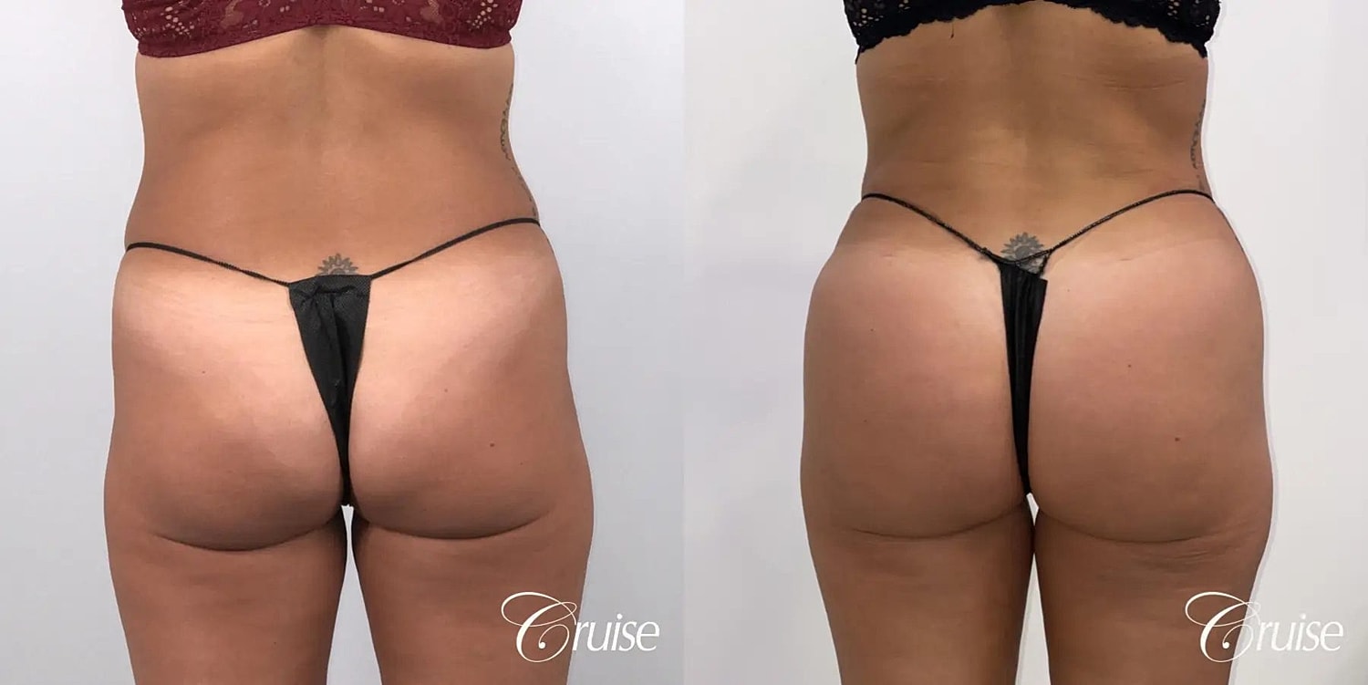 Brazilian Butt Lift Before & After