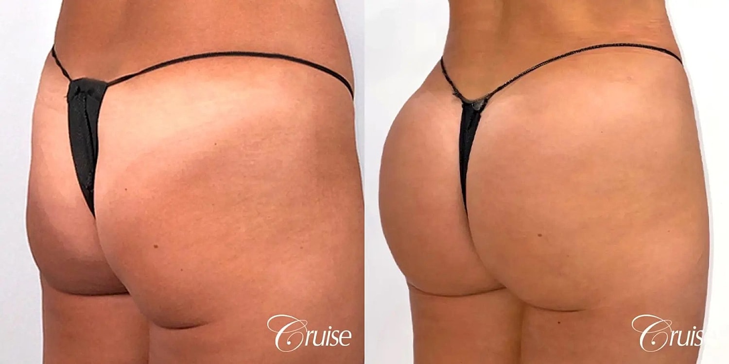 Brazilian Butt Lift Before & After