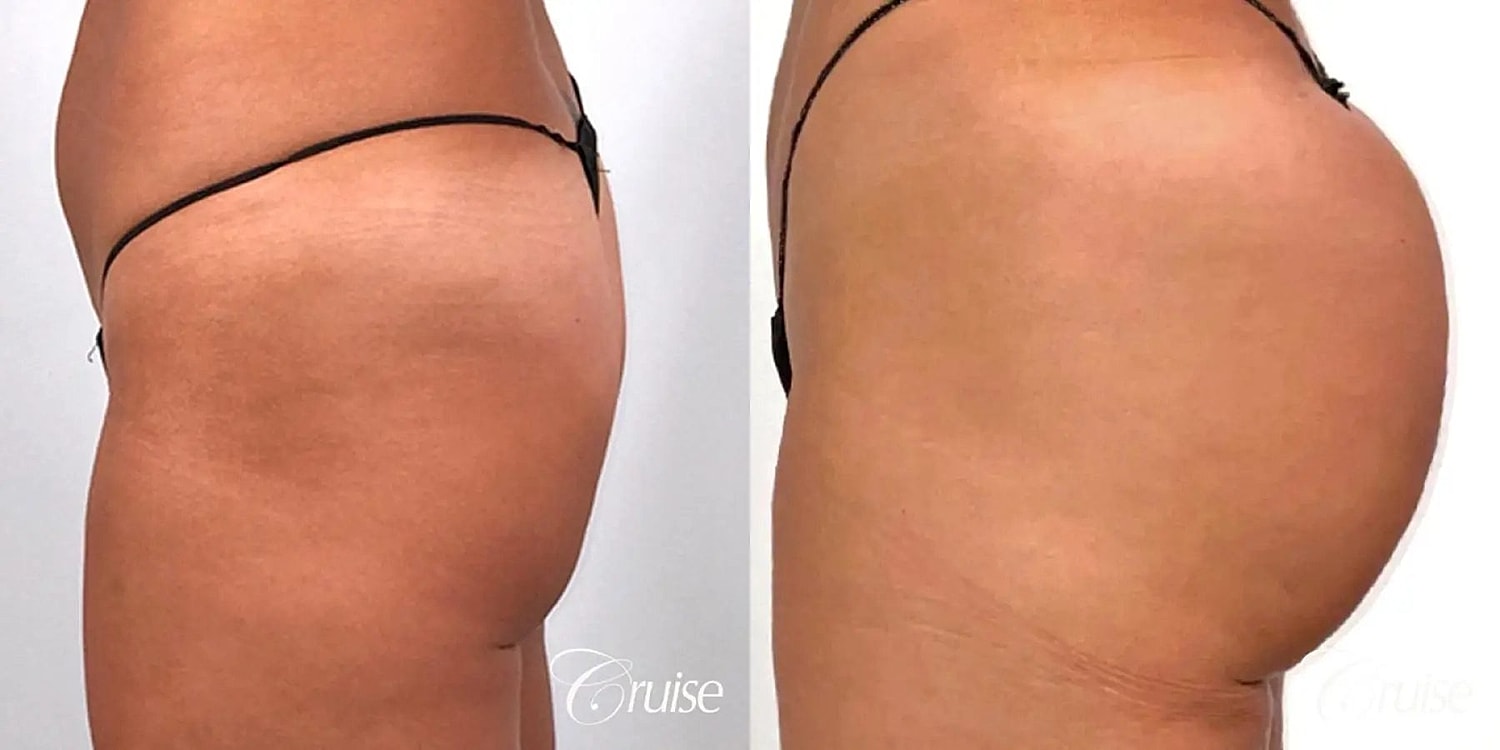 Brazilian Butt Lift Before & After