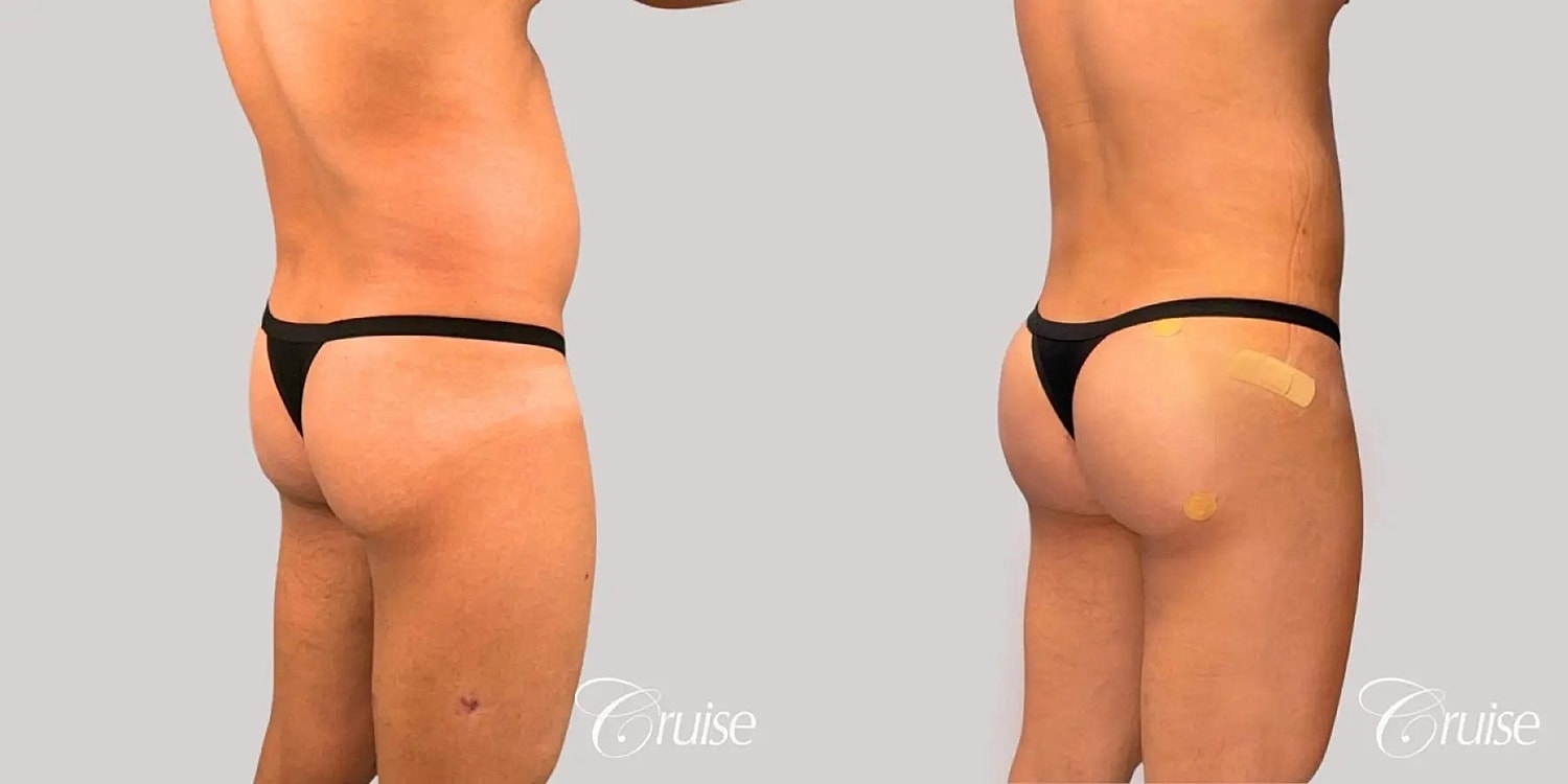 Brazilian Butt Lift Before & After