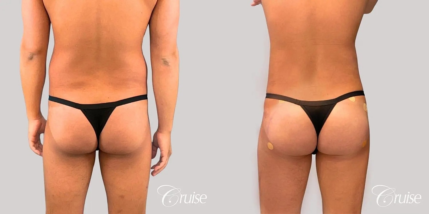Brazilian Butt Lift Before & After