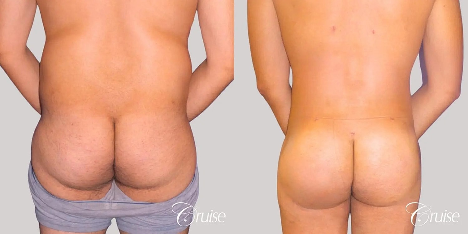 Brazilian Butt Lift Before & After
