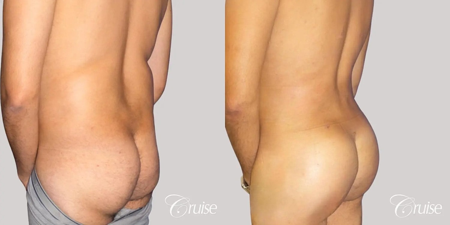 Brazilian Butt Lift Before & After
