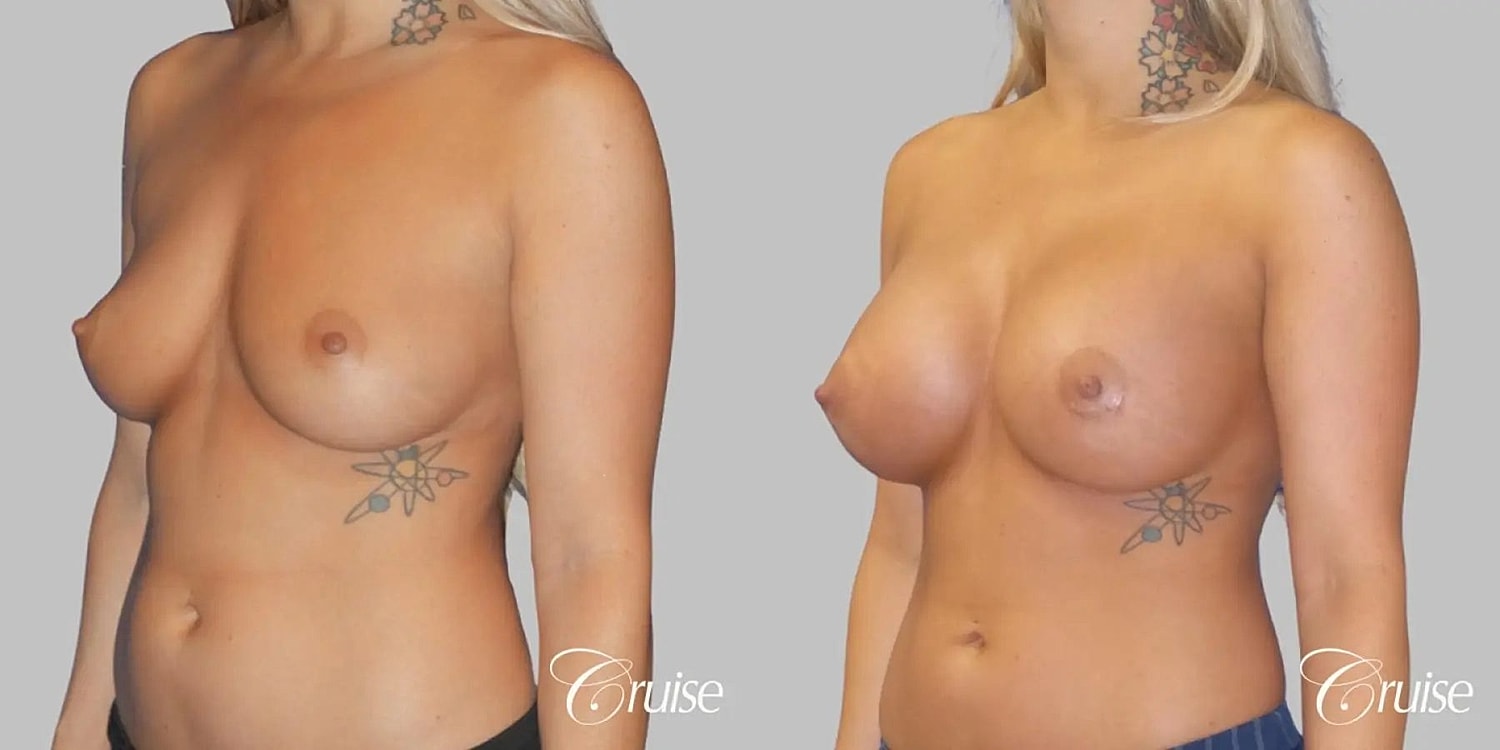 Breast Augmentation Before & After