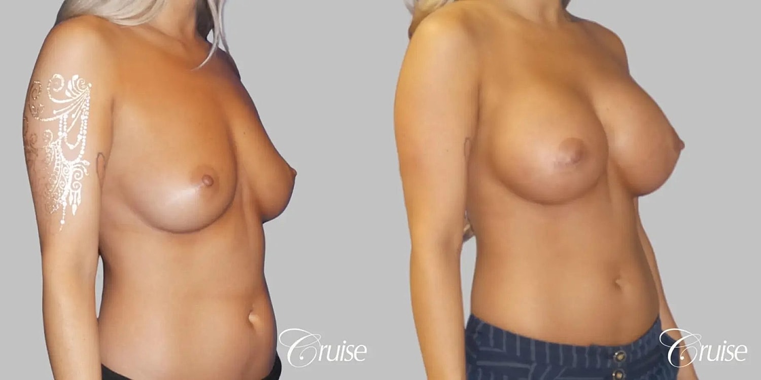 Breast Augmentation Before & After