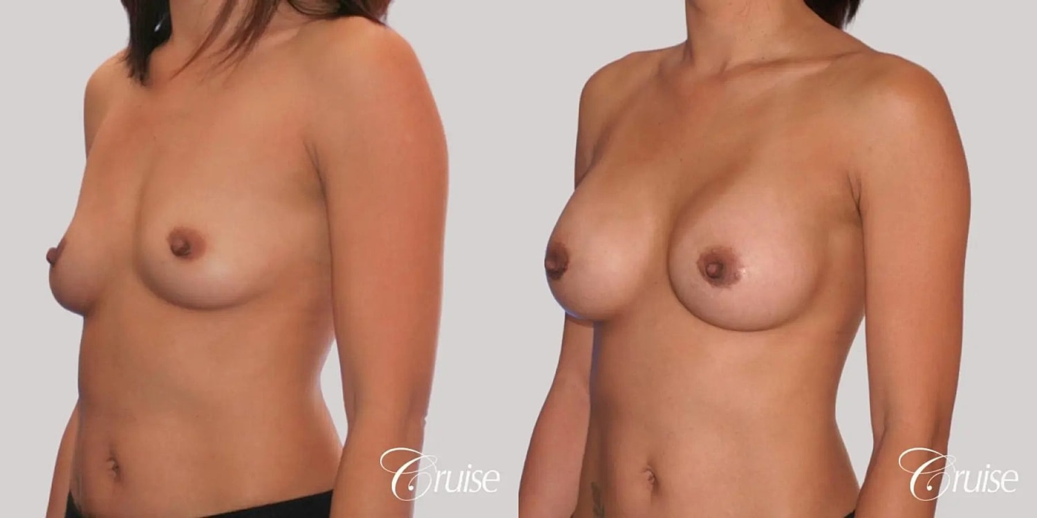 Breast Augmentation Before & After