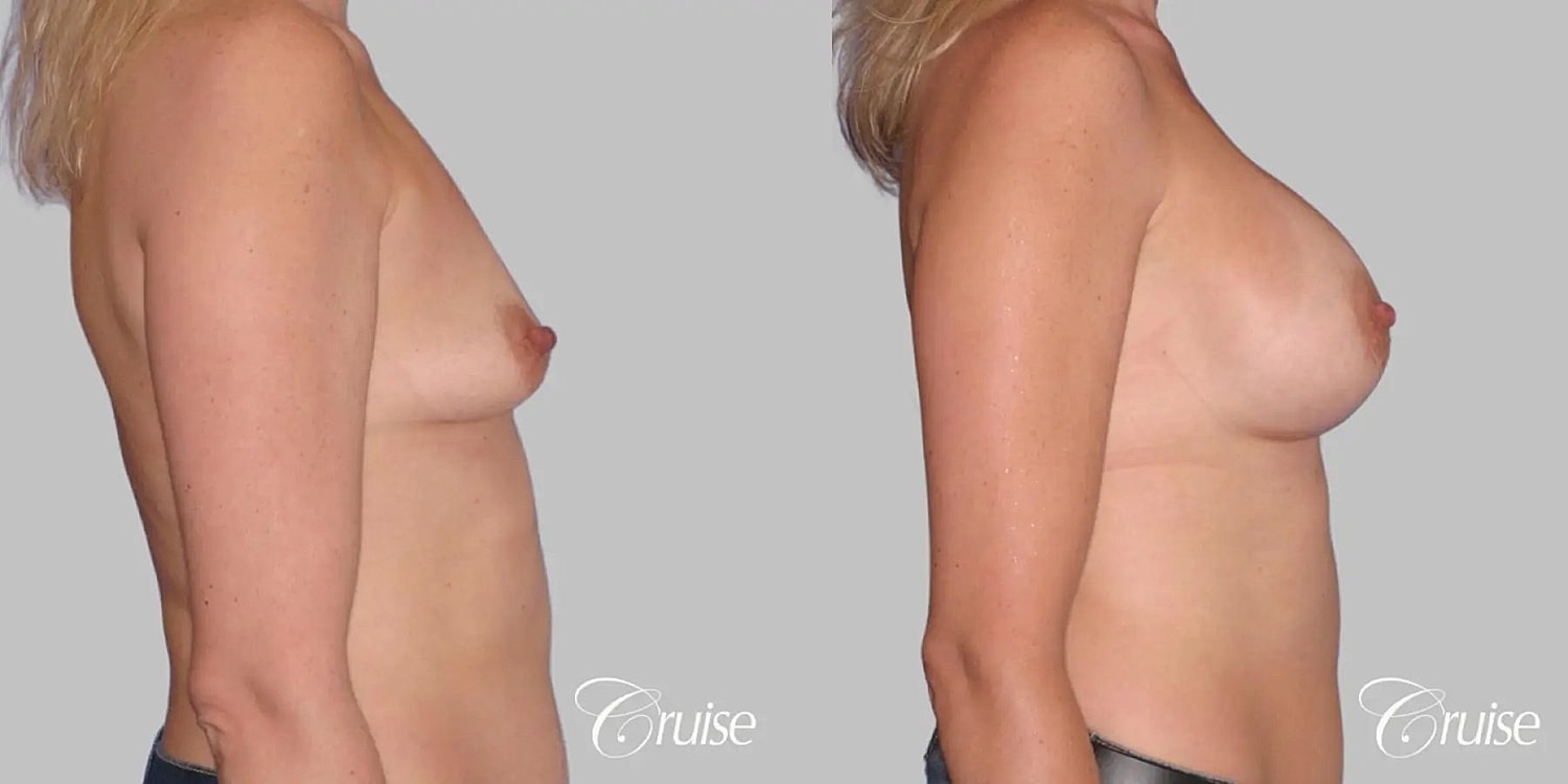 Breast Augmentation Before & After