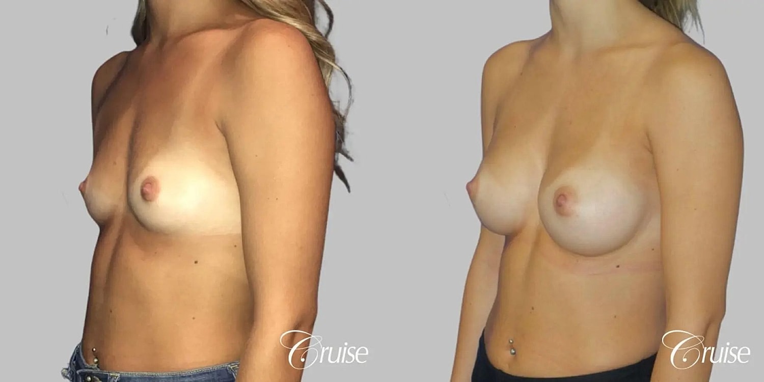 Breast Augmentation Before & After