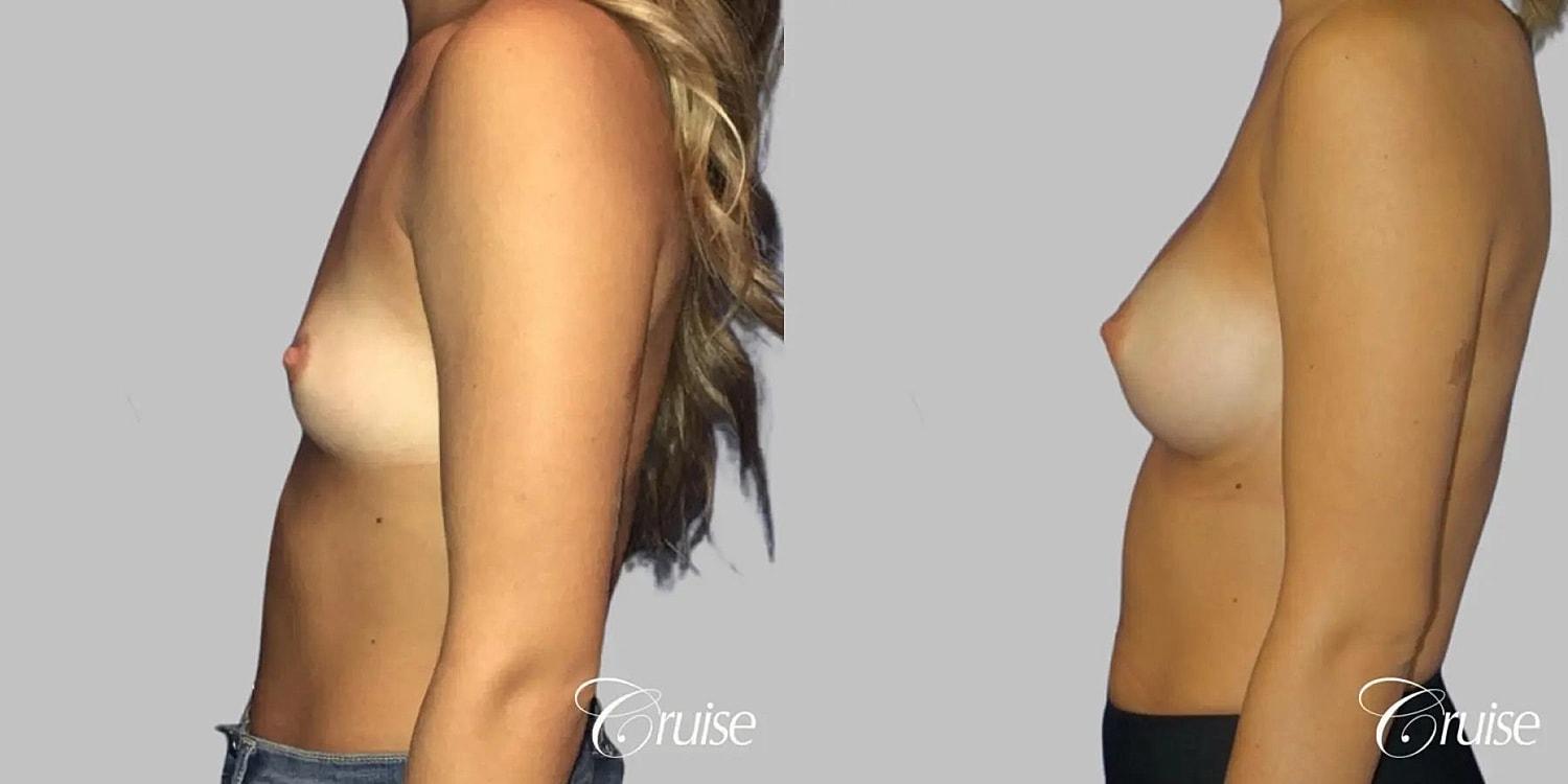Breast Augmentation Before & After
