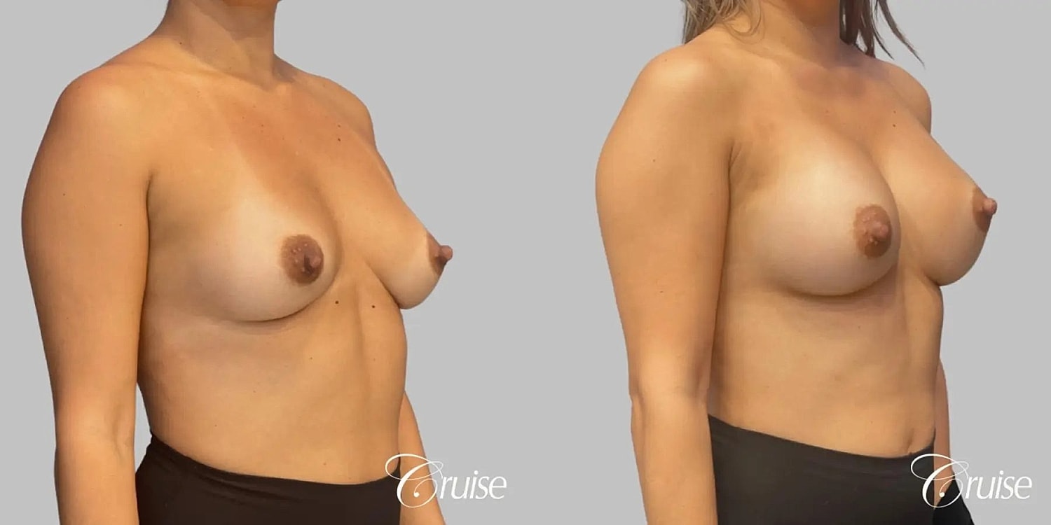 Breast Augmentation Before & After