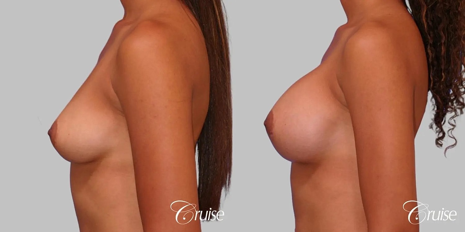 Breast Augmentation Before & After