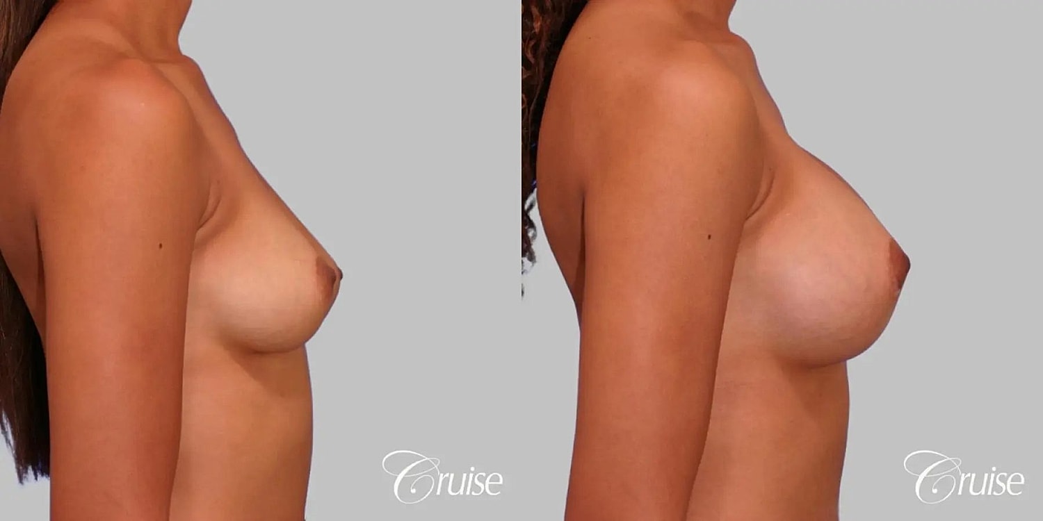 Breast Augmentation Before & After