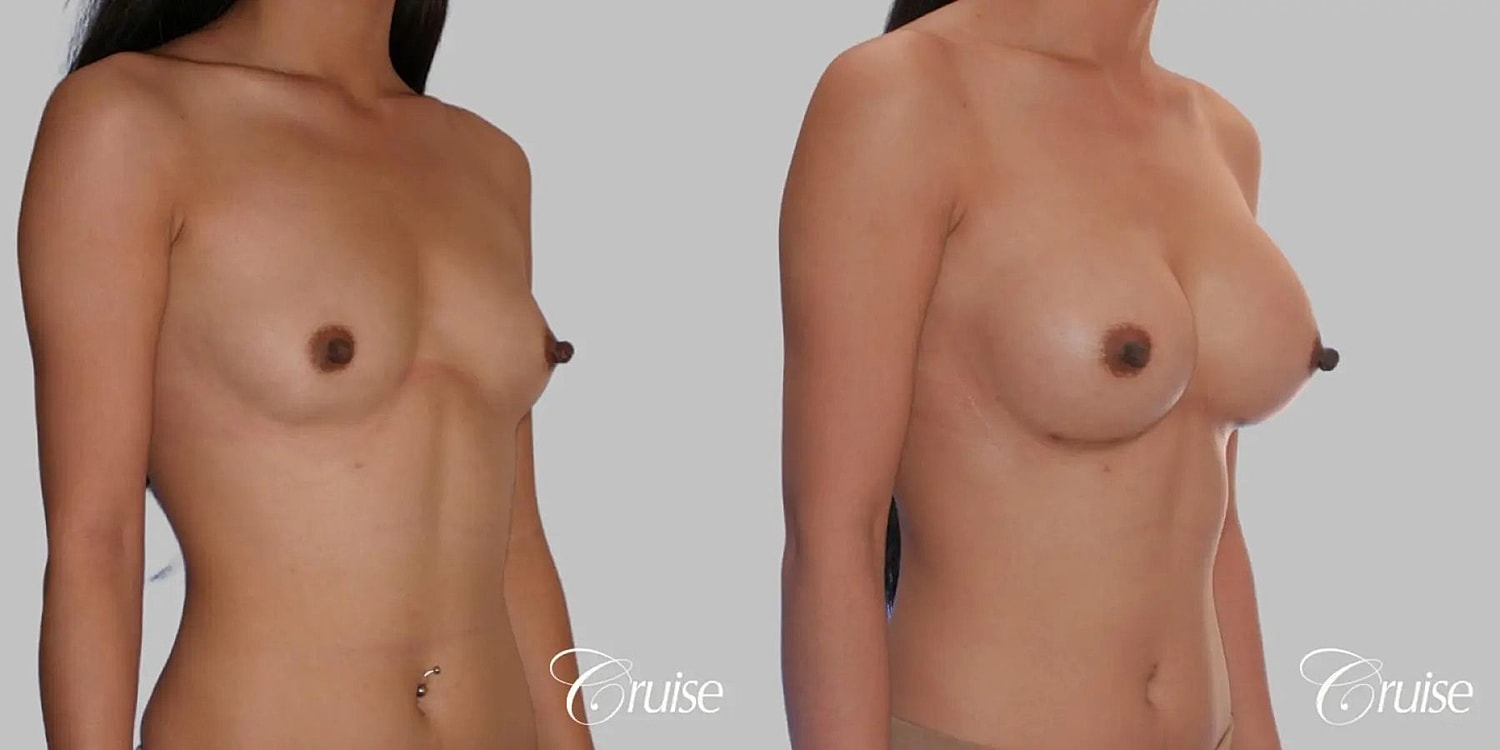 Breast Augmentation Before & After