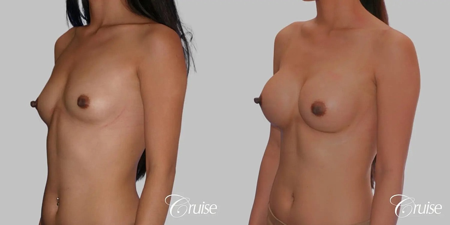 Breast Augmentation Before & After