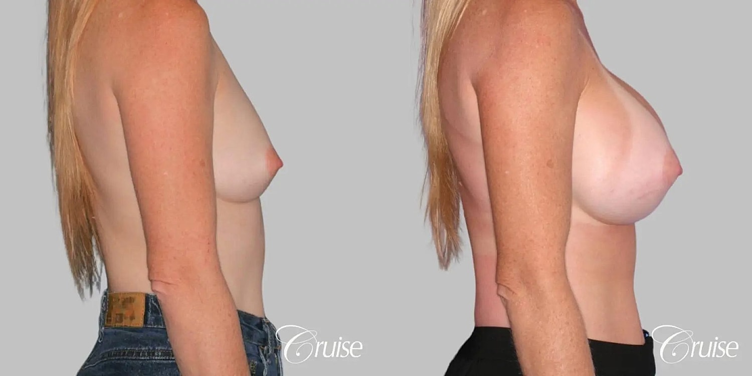 Breast Augmentation Before & After