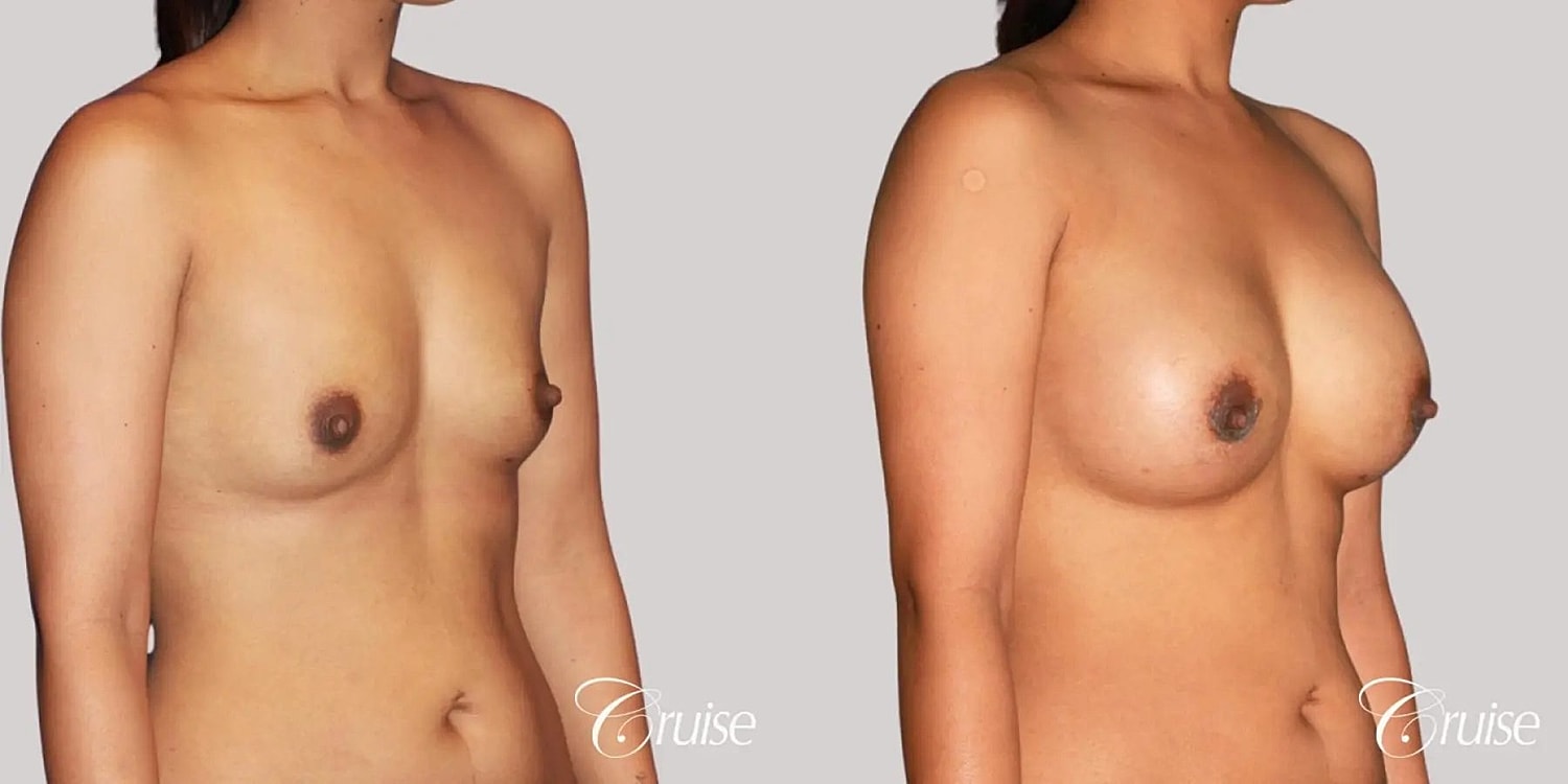 Breast Augmentation Before & After