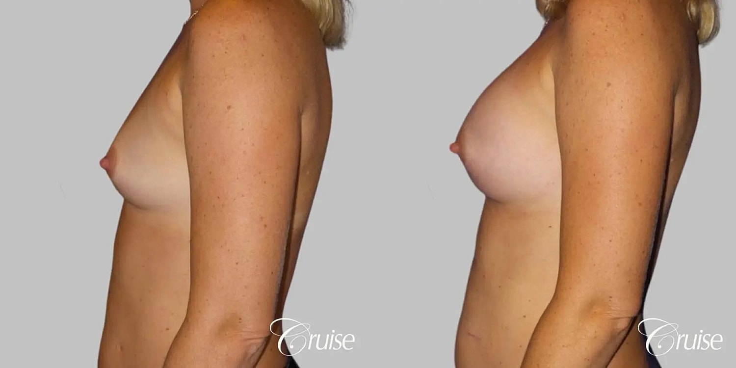 Breast Augmentation Before & After