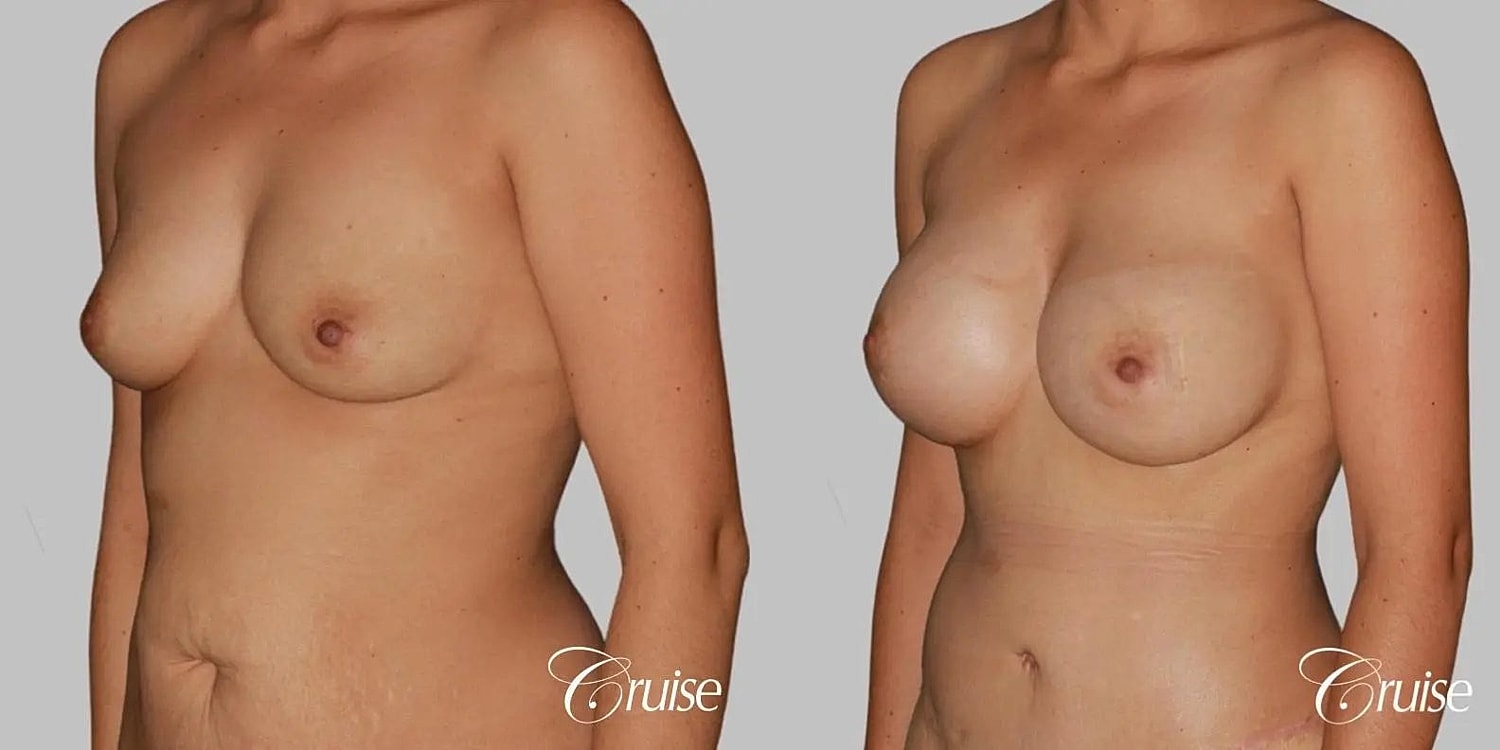 Breast Augmentation Before & After