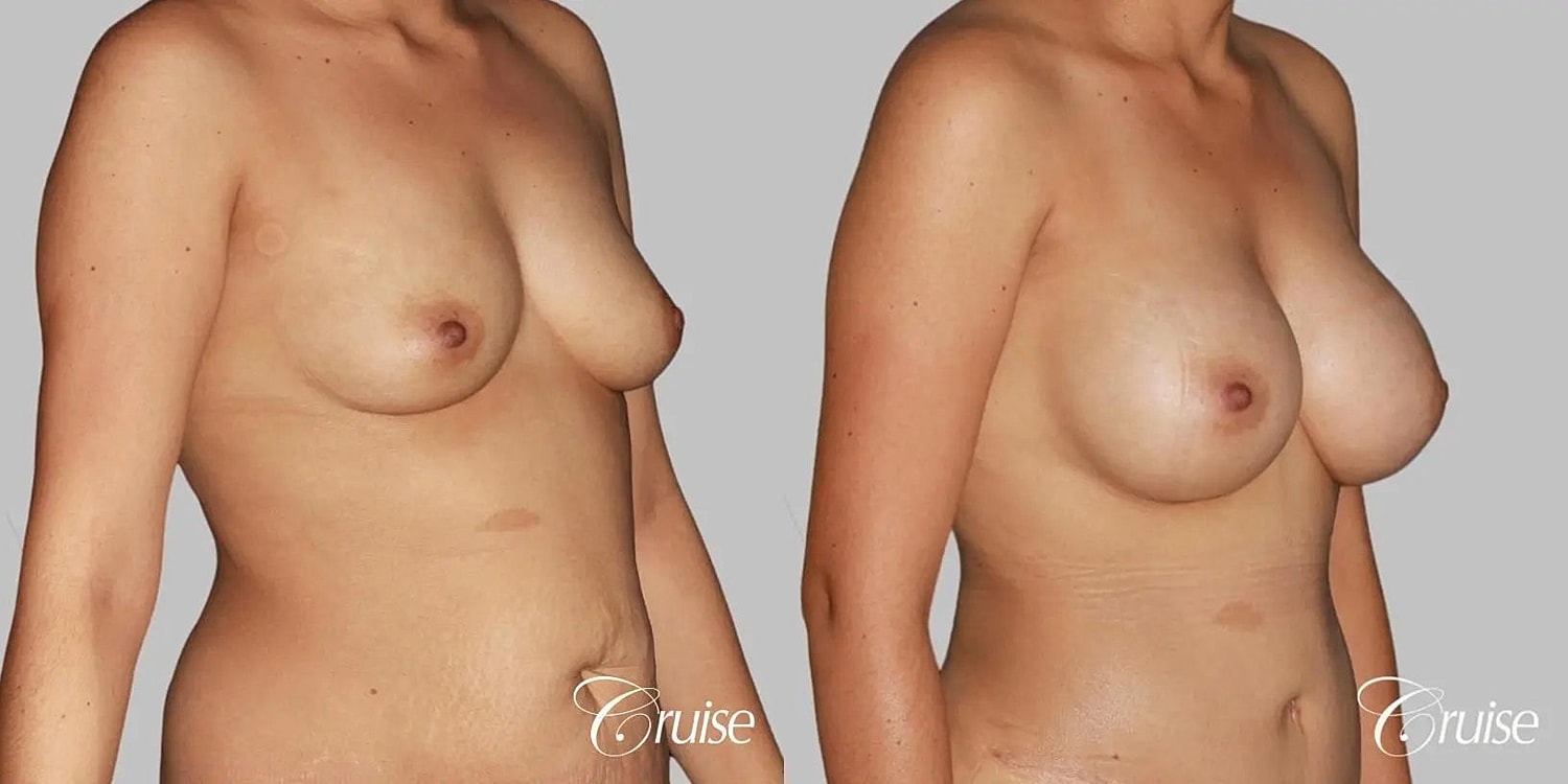 Breast Augmentation Before & After