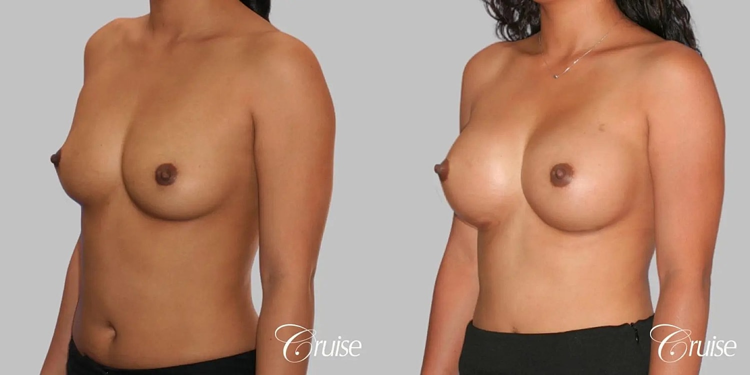 Breast Augmentation Before & After