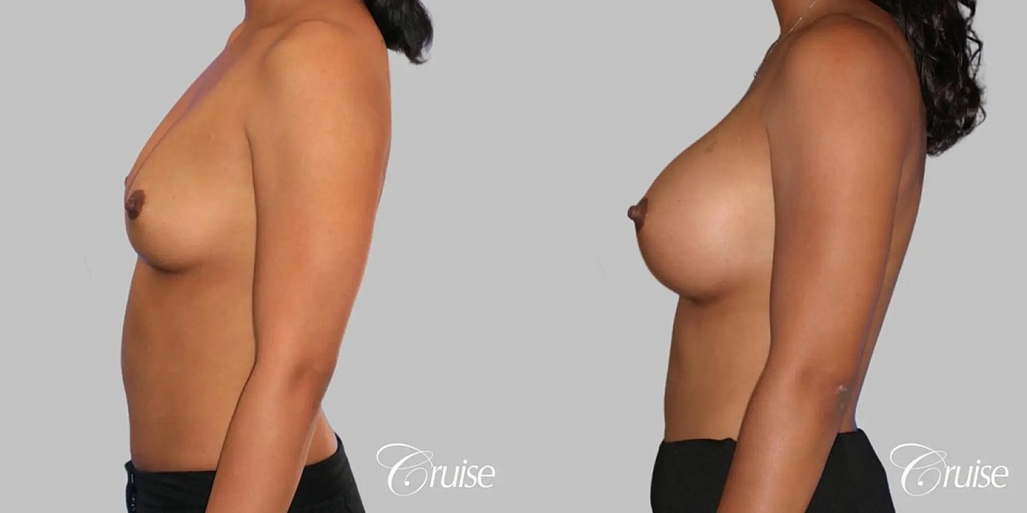 Breast Augmentation Before & After