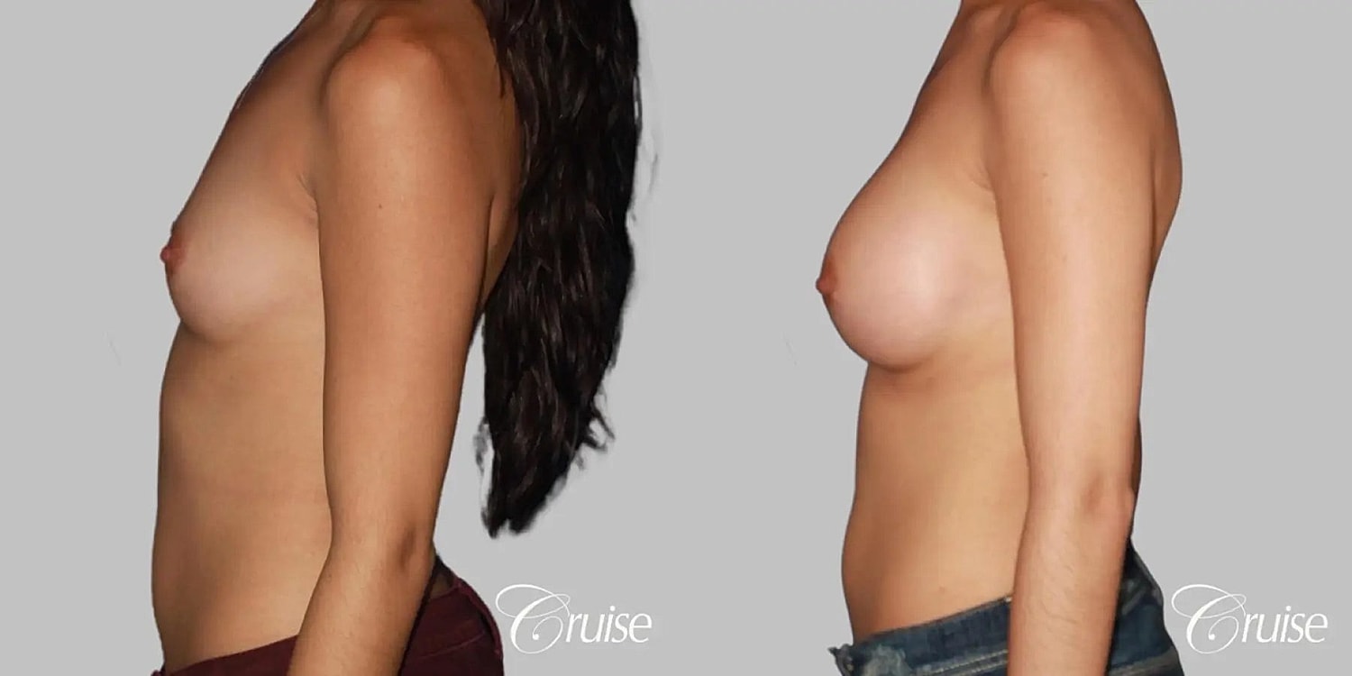 Breast Augmentation Before & After