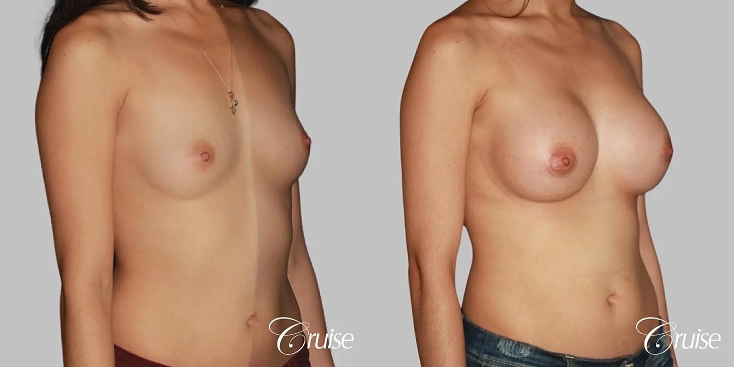 Breast Augmentation Before & After