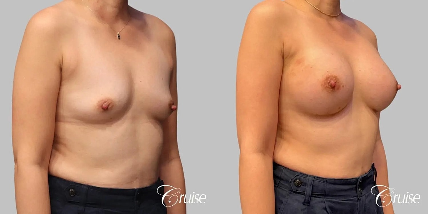 Breast Augmentation Before & After