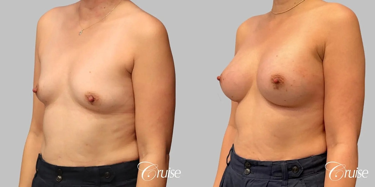 Breast Augmentation Before & After