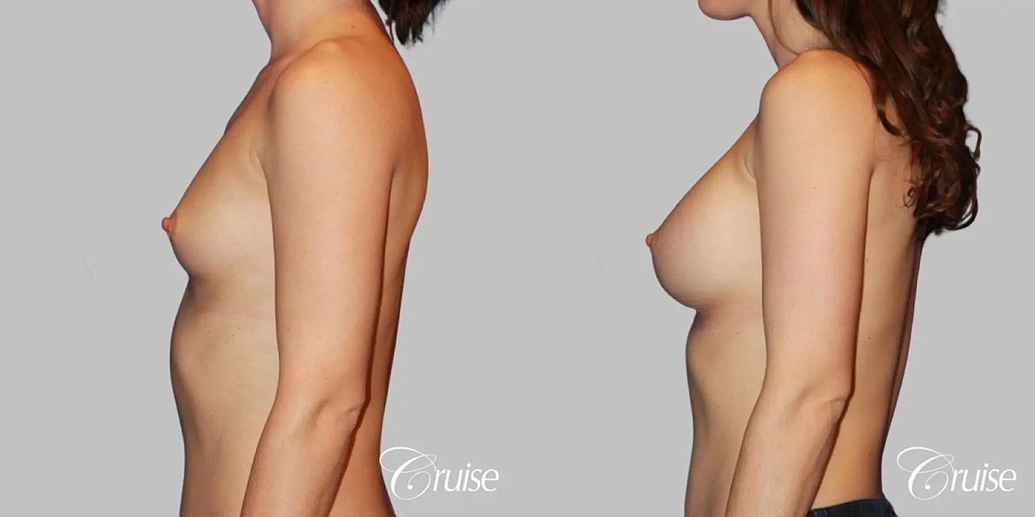 Breast Augmentation Before & After