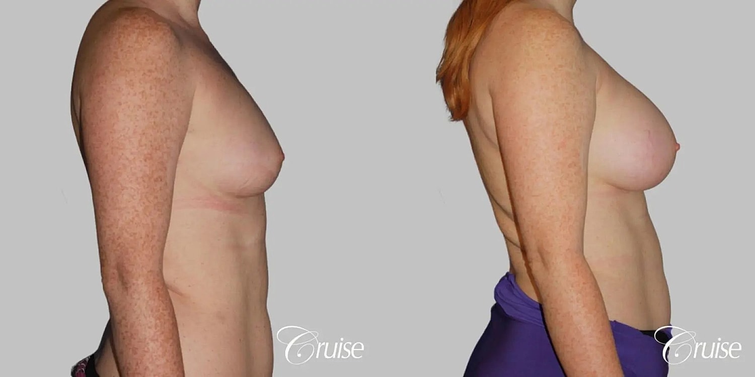 Breast Augmentation Before & After