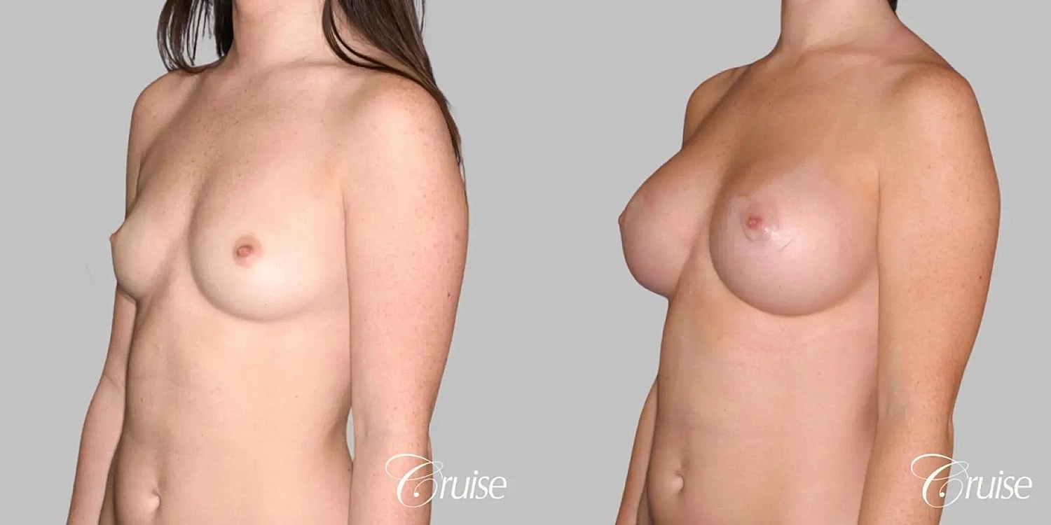 Breast Augmentation Before & After