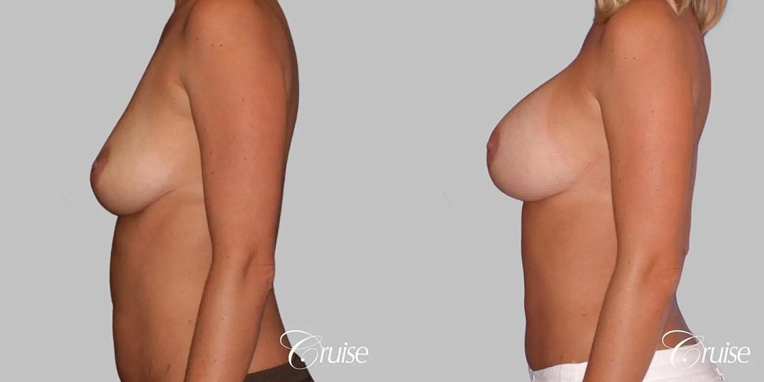 Breast Augmentation Before & After