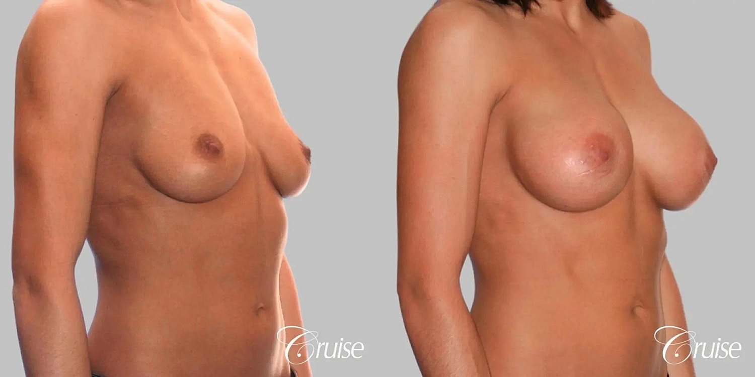 Breast Augmentation Before & After