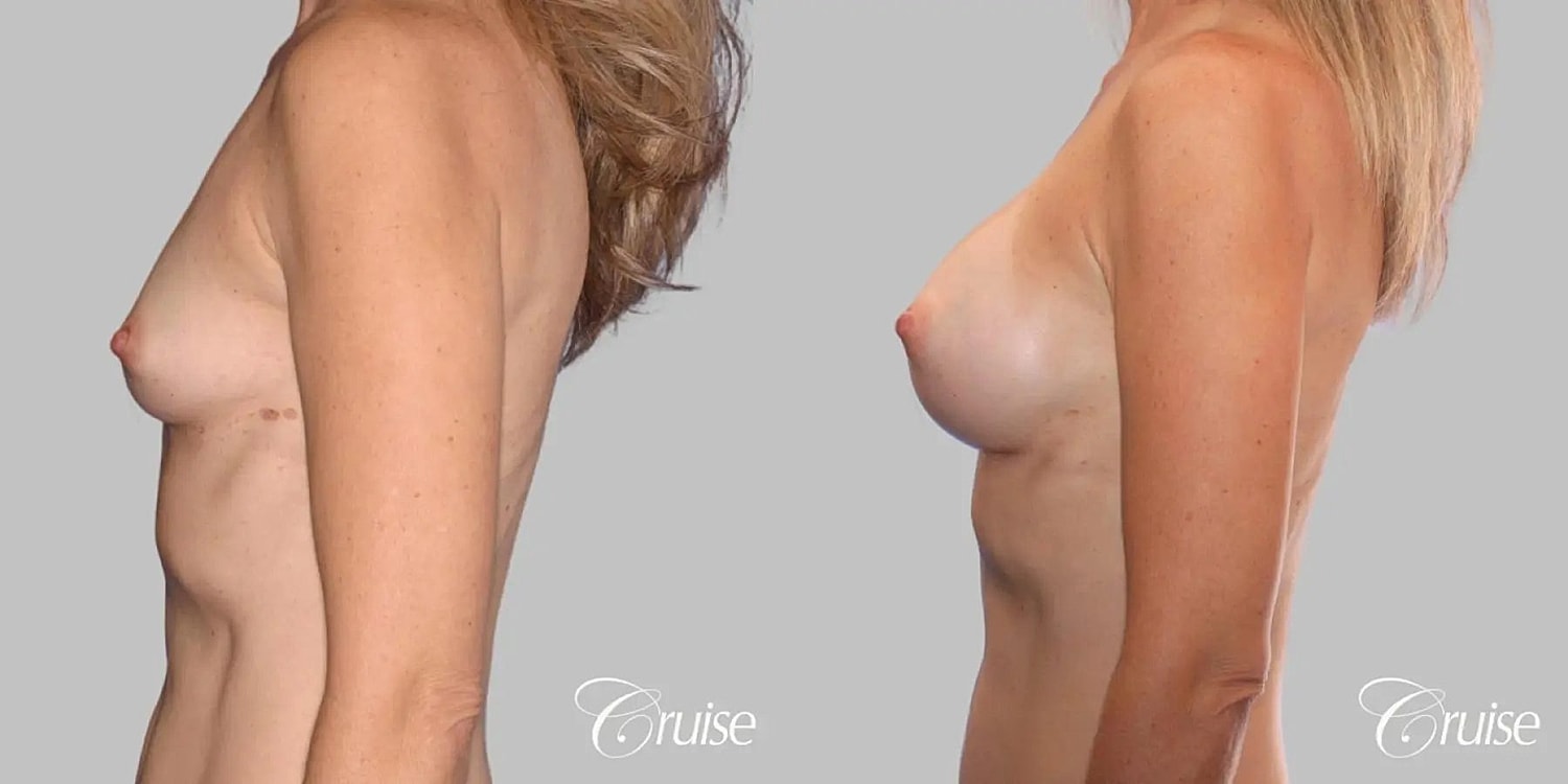 Breast Augmentation Before & After