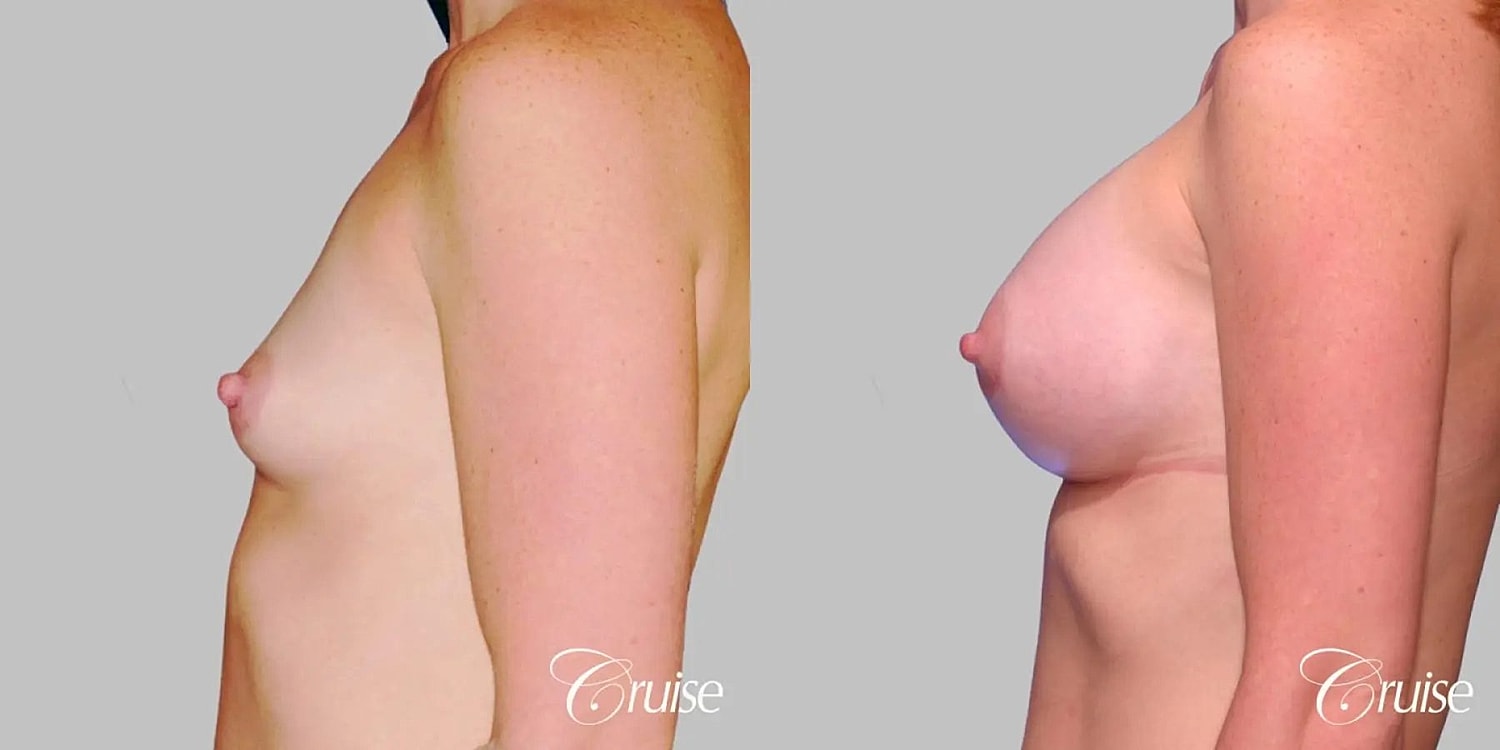 Breast Augmentation Before & After