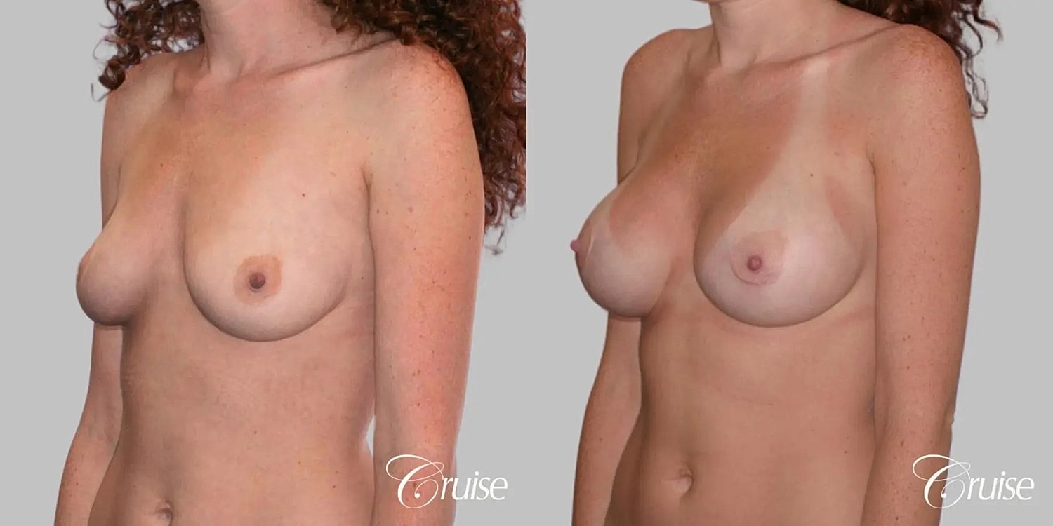 Breast Augmentation Before & After