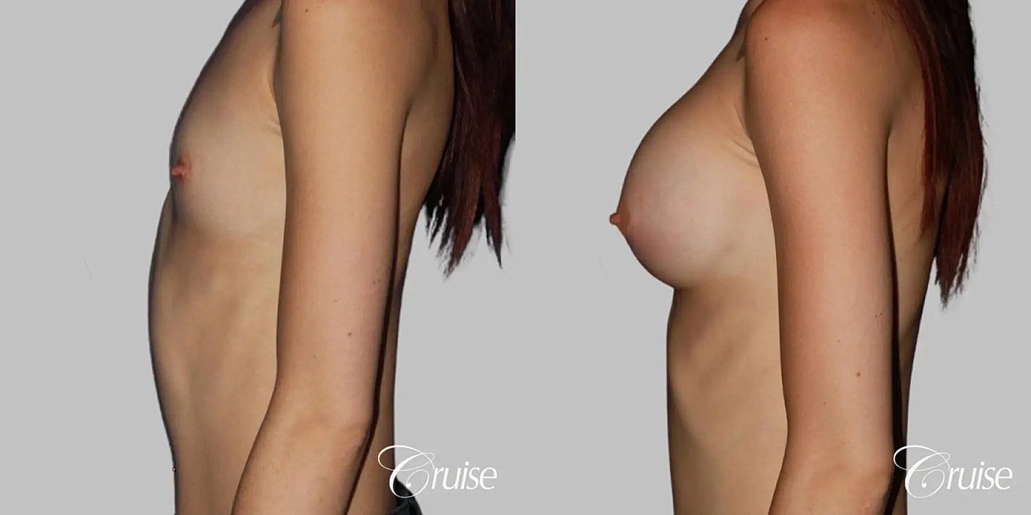 Breast Augmentation Before & After